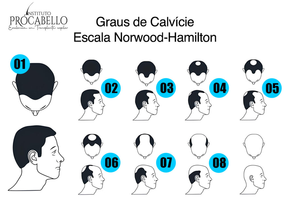 Graus de calvície masculina e feminina - Escalas Norwood-Hamilton e Ludwig